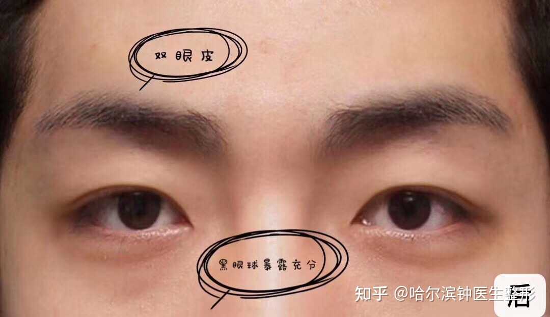 如何看待男生割双眼皮