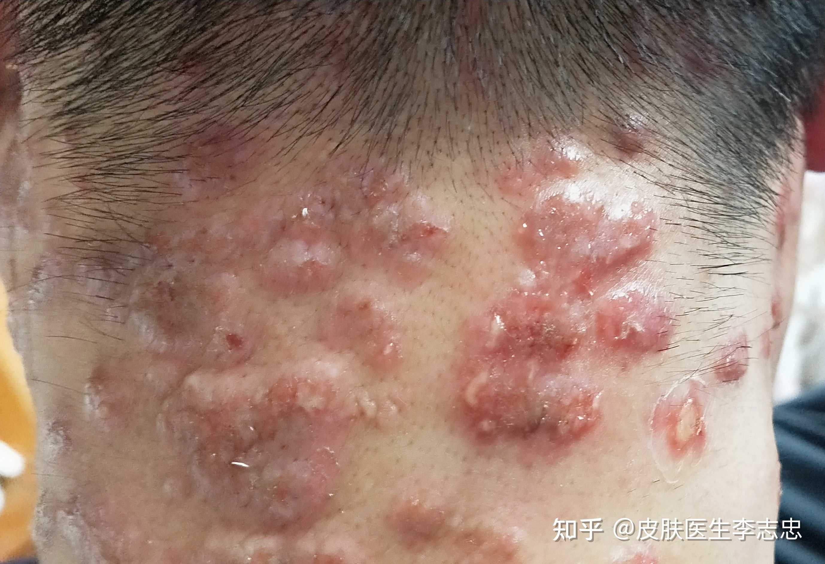 皮肤医生李志忠