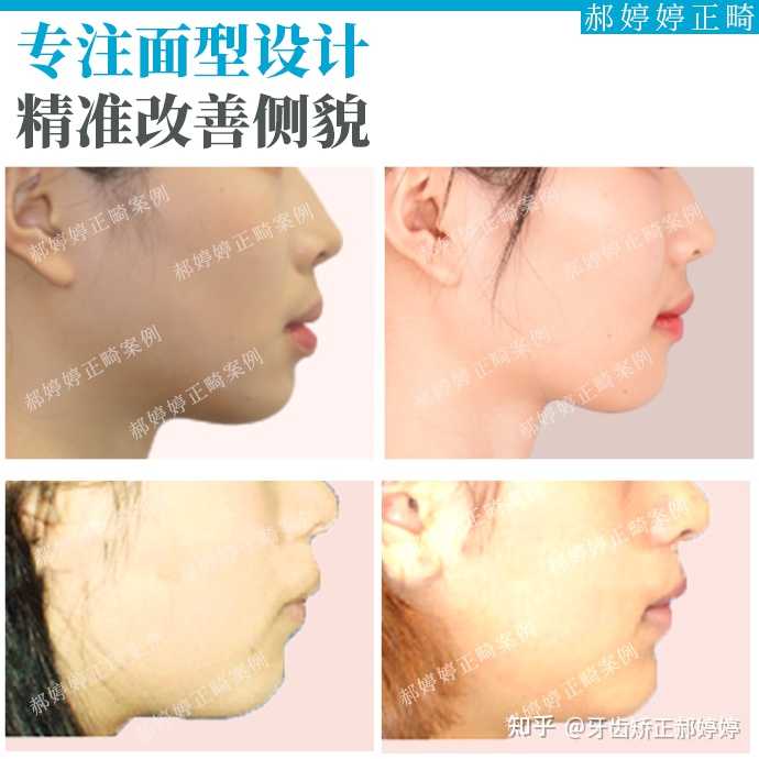 牙齿矫正郝婷婷 的想法: #郝婷婷五官面相分析# 从制