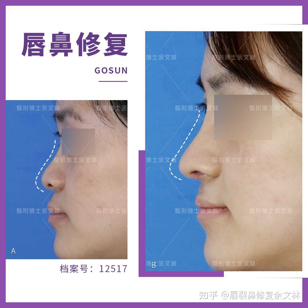 唇裂修复需要多少钱