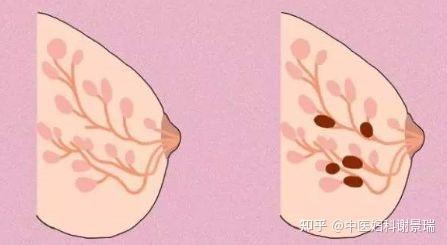 科普乳腺增生与结节的区别