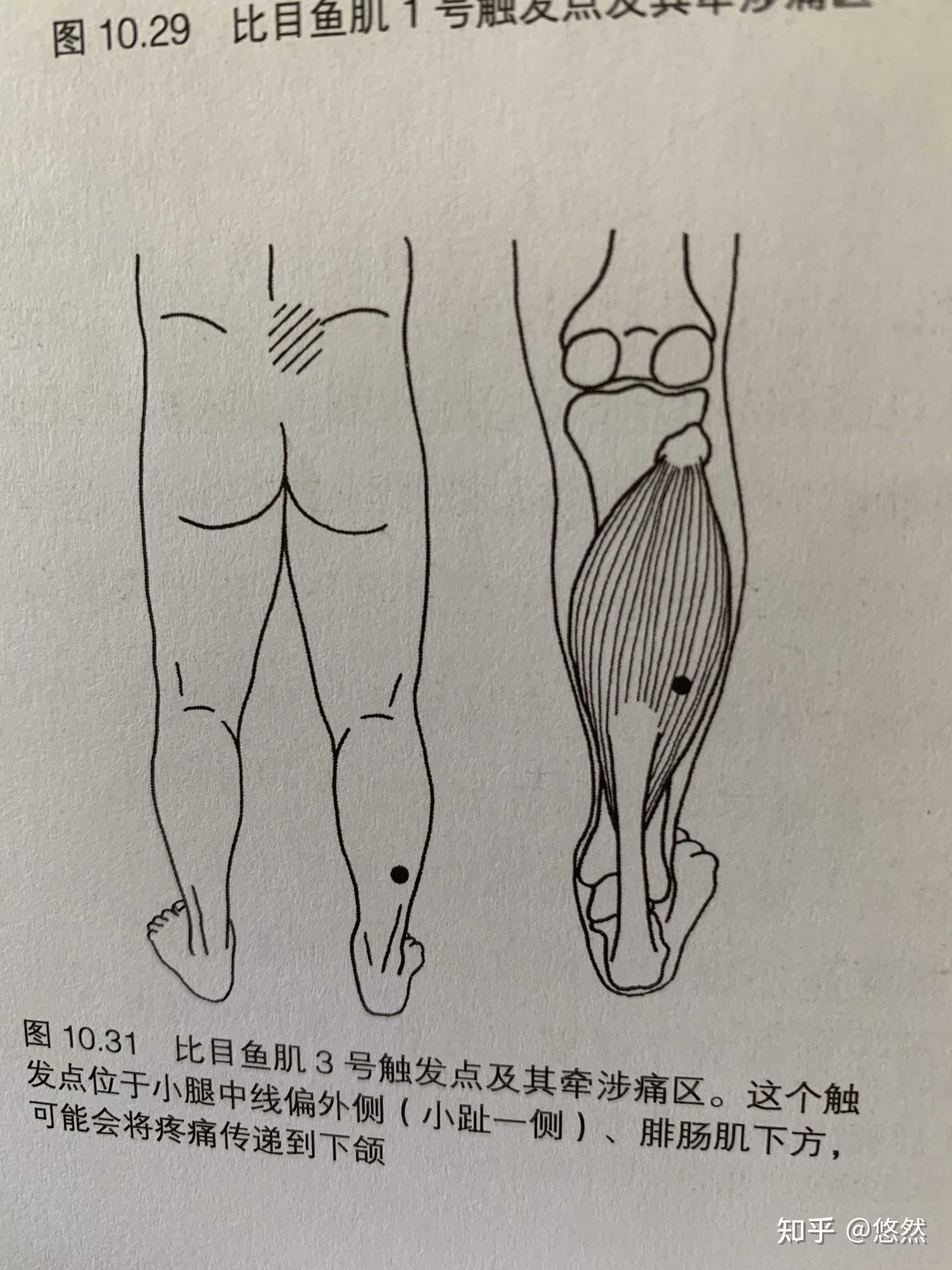 悠然 的想法: 骶髂关节深处疼痛竟然还与比目鱼肌触发