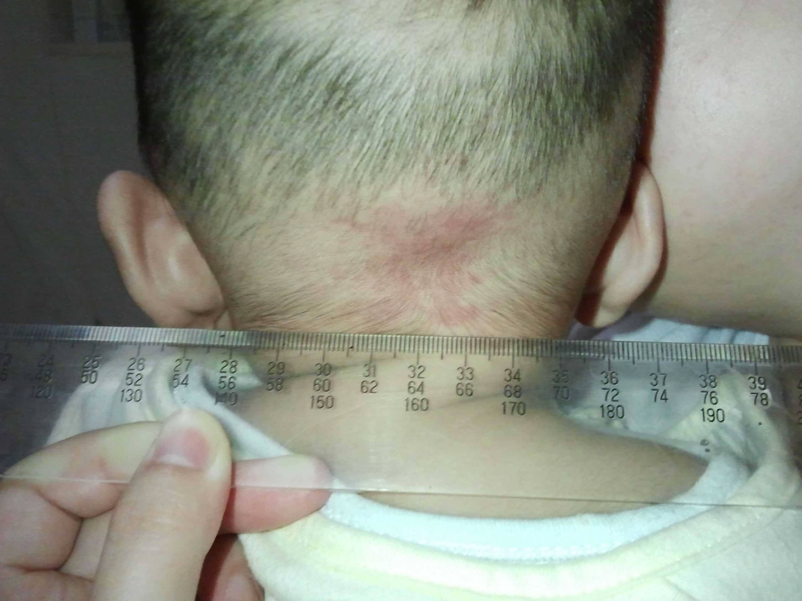 宝宝4个月后脑勺有一小片发红不像是疙瘩热的时候明显请问是什么