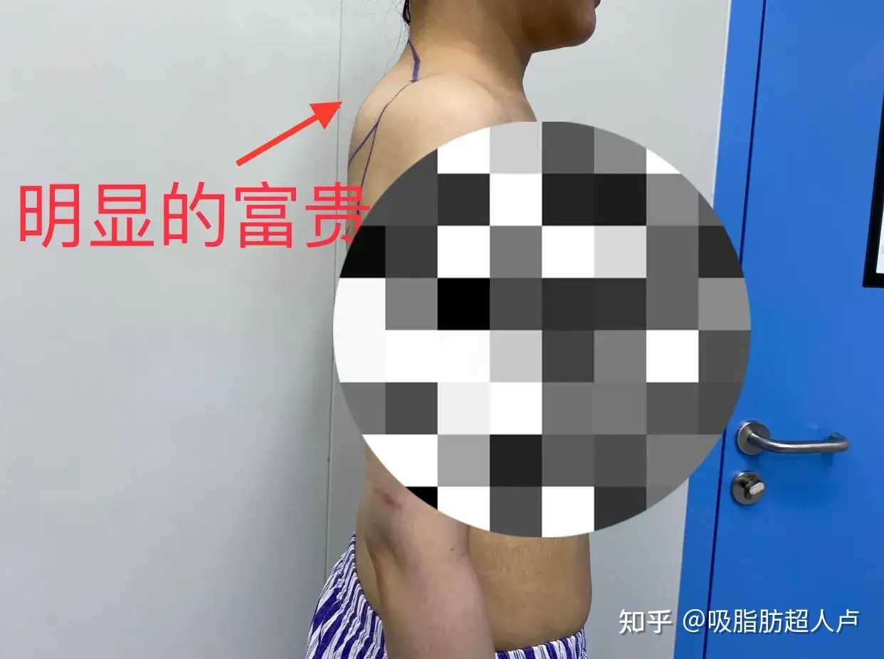 吸脂肪超人卢 的想法: 更新一组中度#富贵包吸脂# 吧!