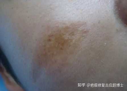 什么是疤痕色素沉着