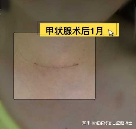 甲状腺手术后一定会留下明显疤痕吗