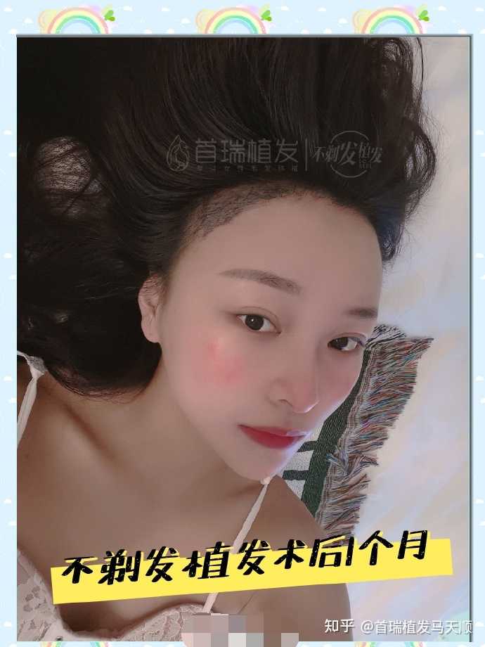 纹发际线vs植发际线对比