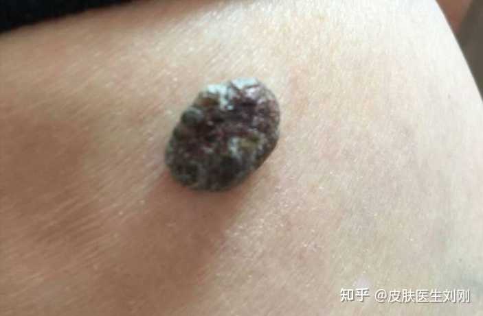 黑色素瘤是什么