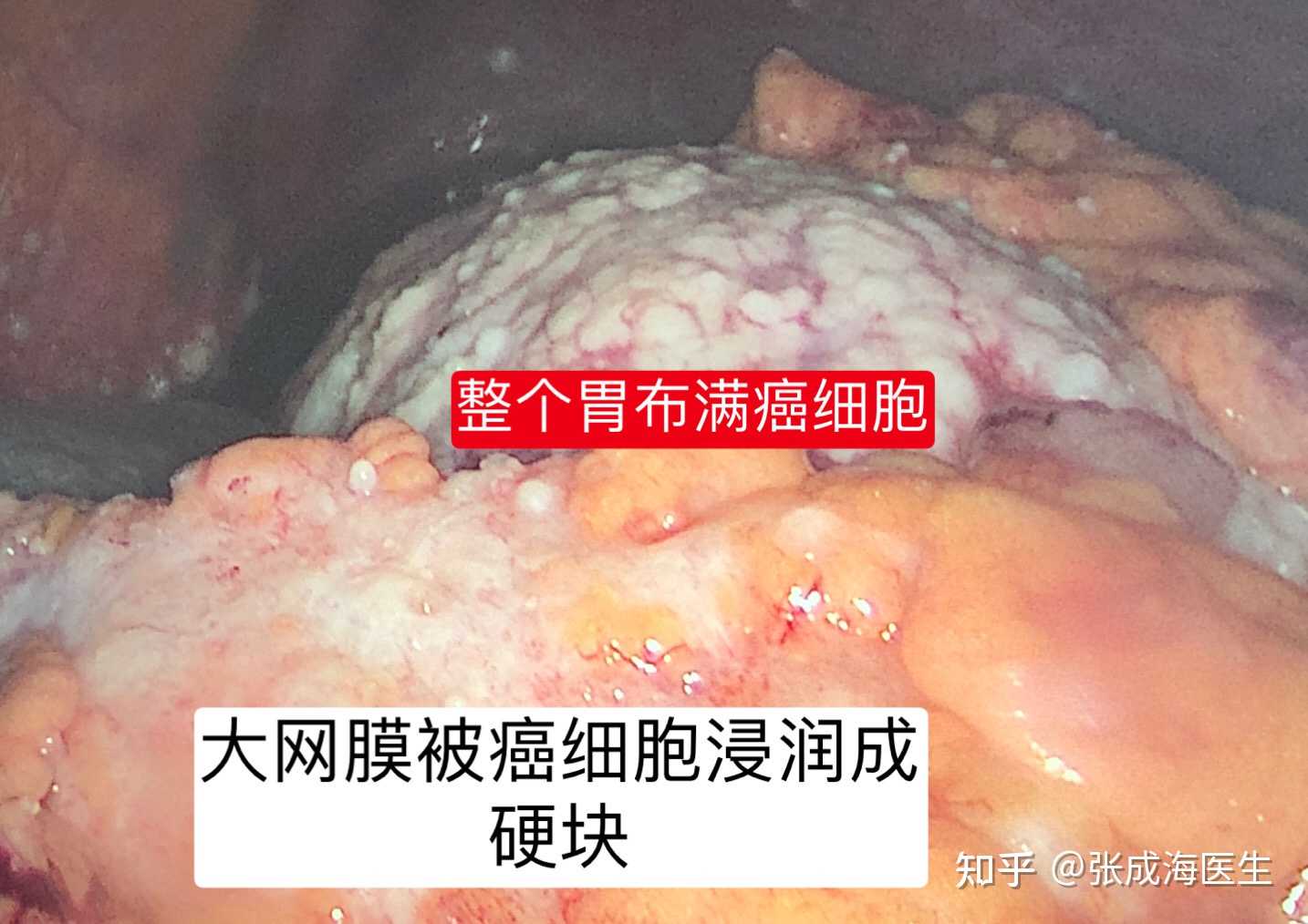 胃癌严重的腹腔转移会长成这样