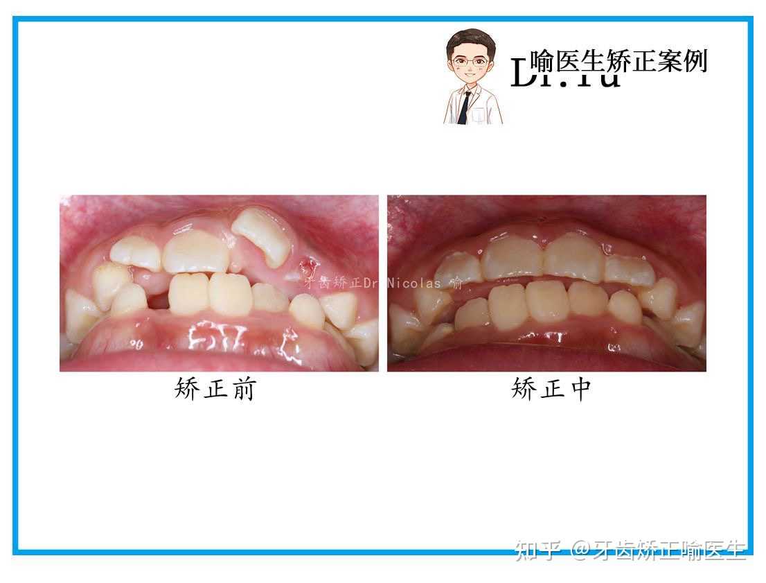 牙齿矫正喻医生 的想法: 门牙外翻,扭转异位,恒牙萌出空间不足 - 知乎