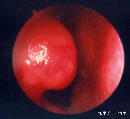 身体受凉为什么会鼻塞