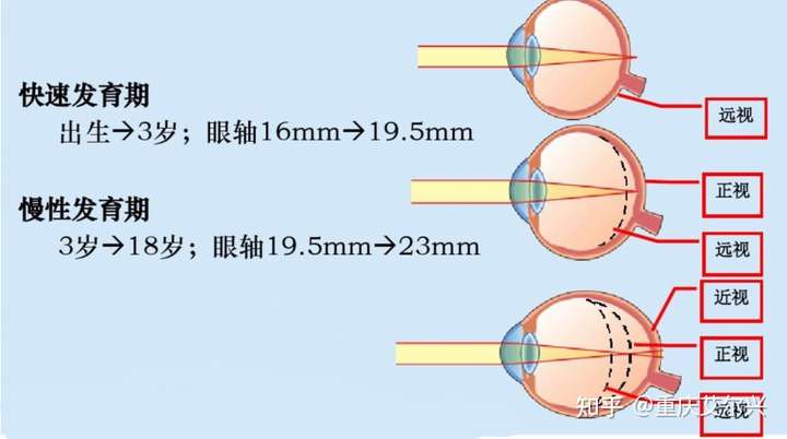 72mm.  从上图可以看到,13岁的眼轴正常值应该在22mm多一点.