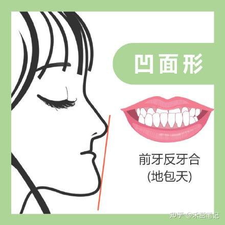 地包天(牙性)属于常见的牙齿畸形问题,长沙的口腔机构那么多,所以能做