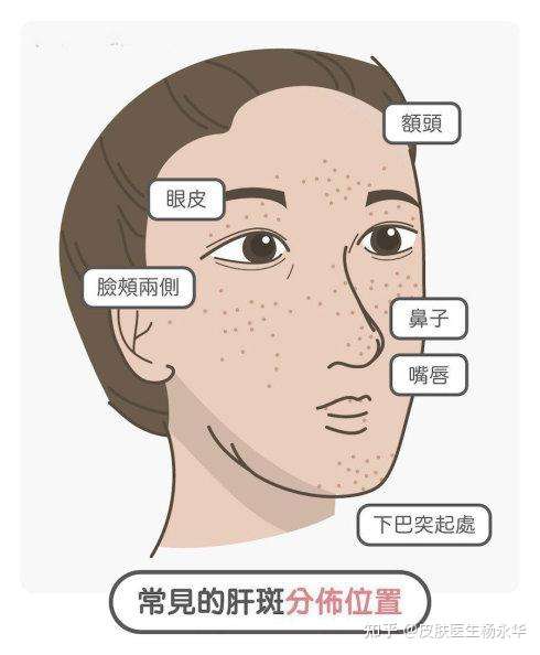 压力会使人产生黄褐斑吗?