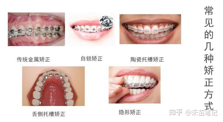 普通金属牙套,金属自锁牙套,陶瓷半隐形牙套,隐形牙套,舌侧牙套.