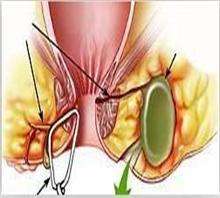 肛瘘手术后三个月了排便后肛门还是很痒是怎么回事