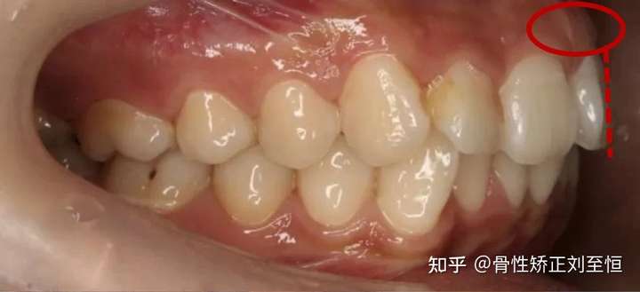 怎样判断嘴凸是骨性的还是牙性的?