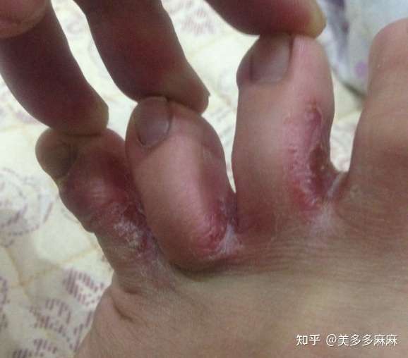 糜烂型脚气一般常见于脚趾缝