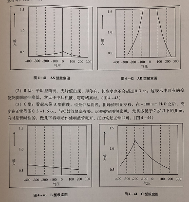 常见的几种异常鼓室压图