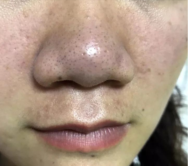 先来看看,不及时清理黑头的鼻子是什么样子