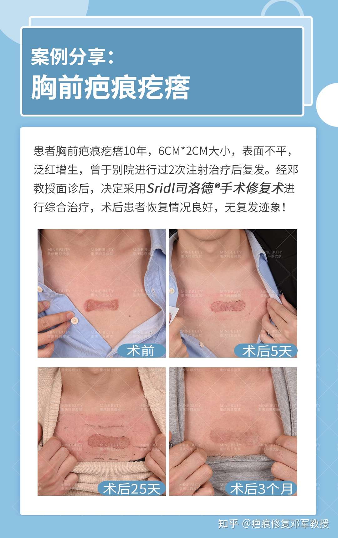 胸前疤痕疙瘩治疗案例