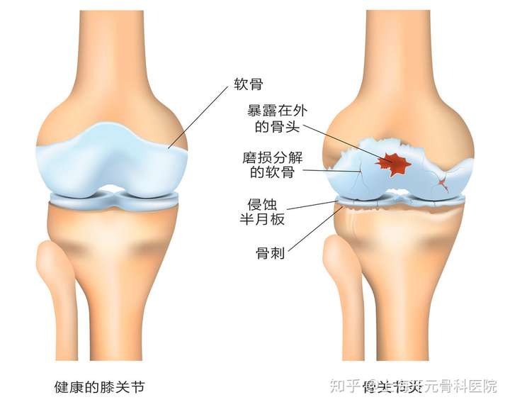 那什么是膝盖骨关节炎,有哪些常见症状,又该如何治疗呢?