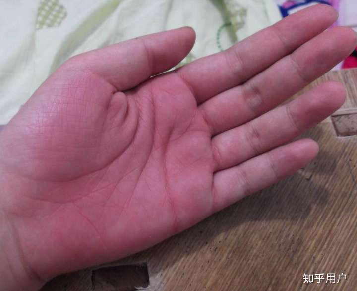 被打手心到肿是种怎样的体验?