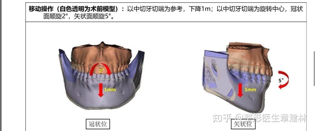 正颌手术的lefort1的上颌前推和顺旋有什么区别