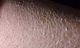 是一种皮肤干燥,鱼鳞状脱屑为主症的皮肤病,典型的症状表现在全身皮肤