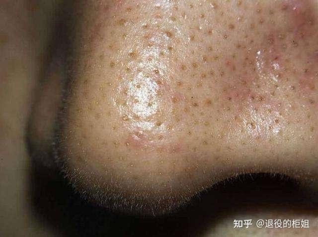 刷酸会改善毛孔大黑头多的问题嘛