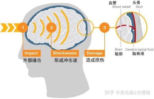 脑震荡的病因是什么有何症状表现治愈后是否存在后遗症
