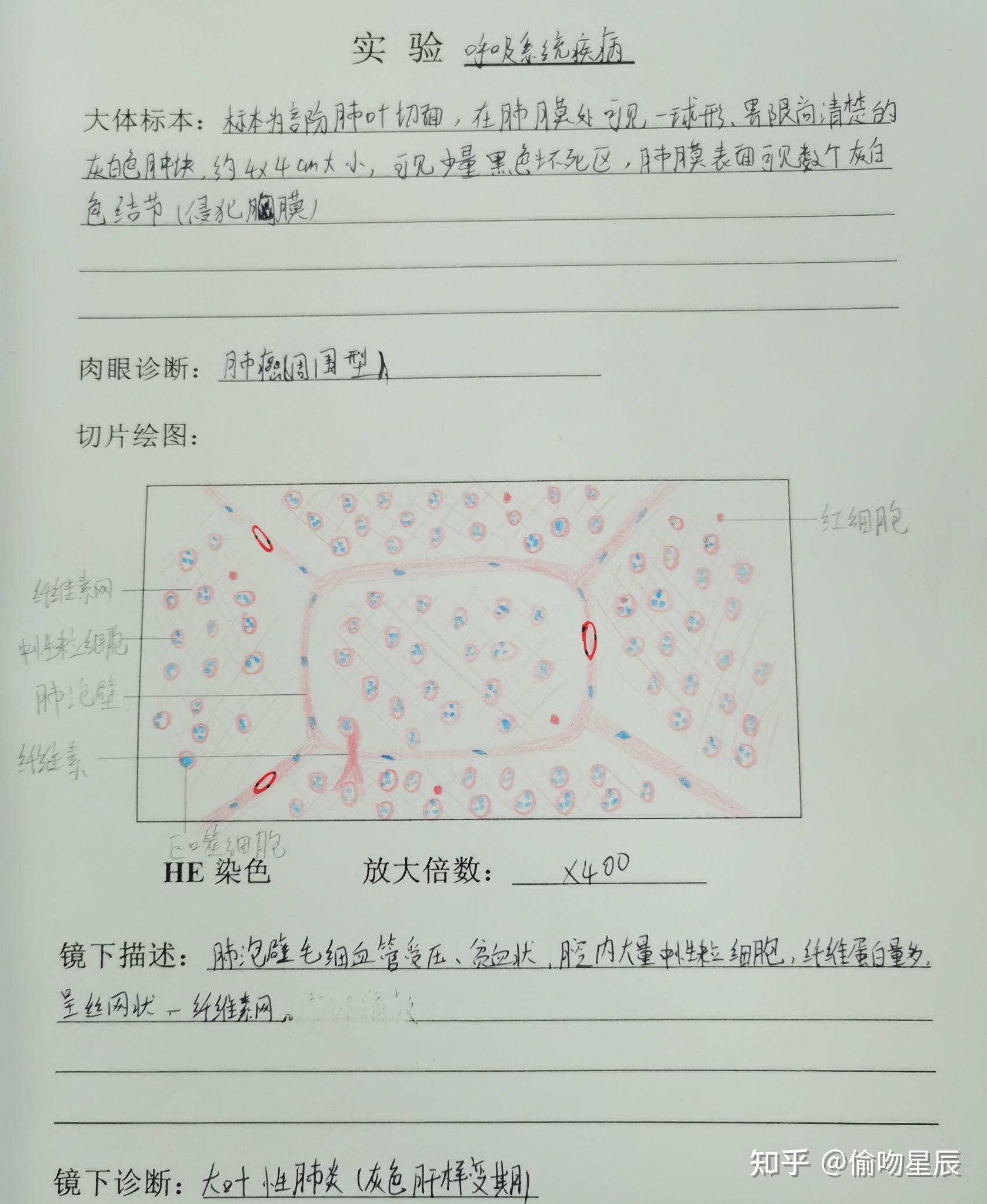 有没有人有病理的结肠腺癌红蓝铅笔手绘图啊