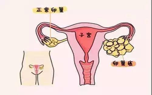 为什么会发生卵巢癌多半是这几个原因