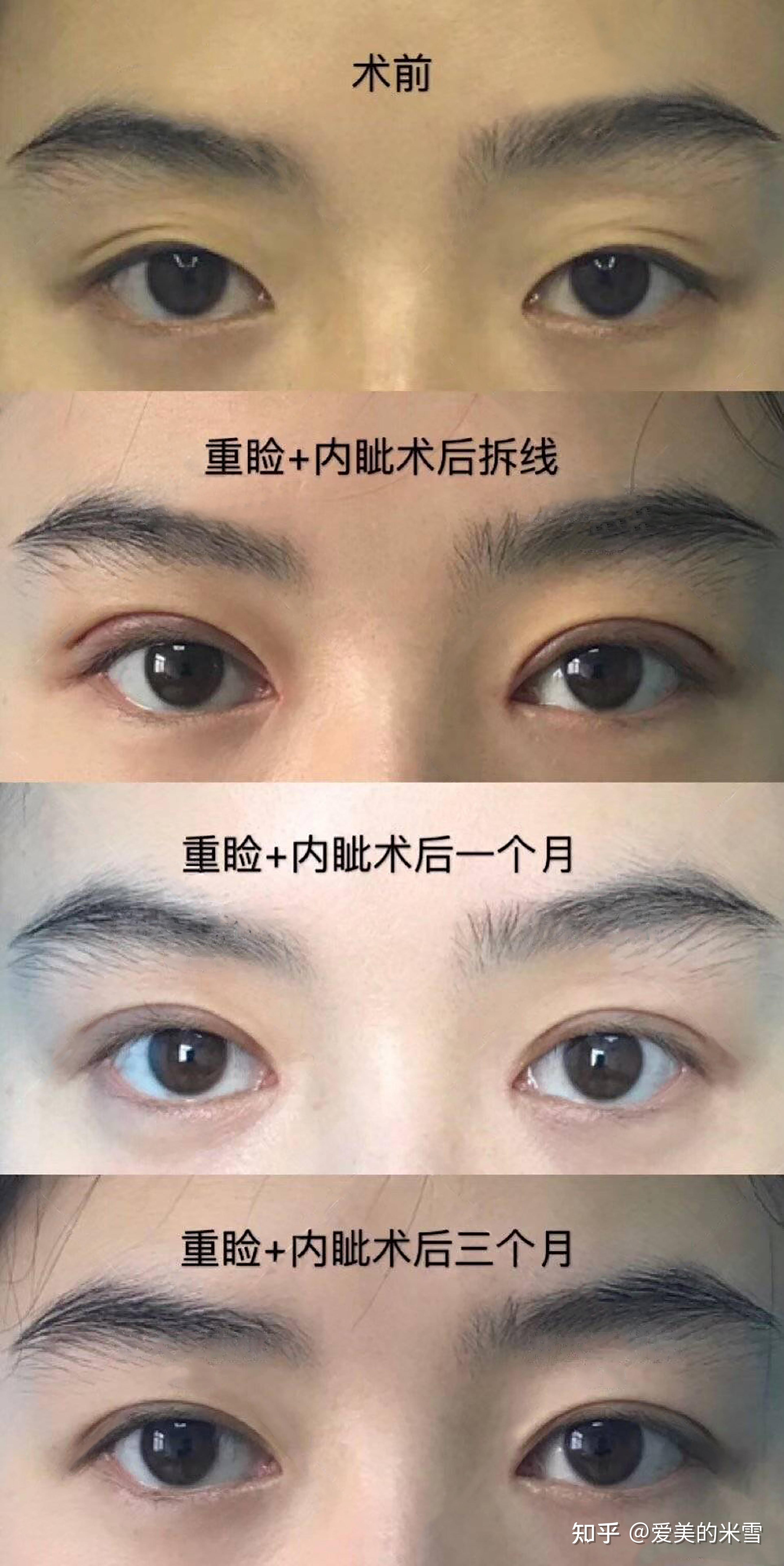 割完双眼皮之后的差距有多大