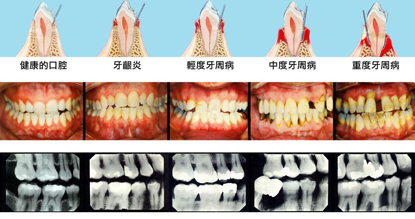 3,创伤性咬合 在咬合时,若咬合力过大或方向异常,超越了牙周组织所能