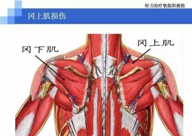 那些被我们忽略的小肌肉系列之冈上肌