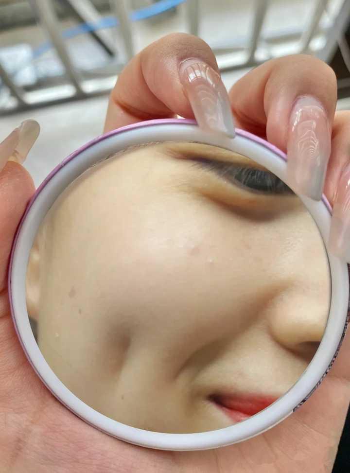 如何快速有效地去痘印
