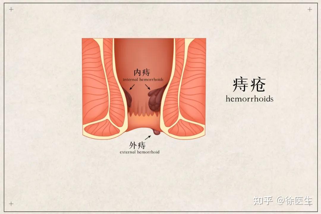 做完痔疮手术后吃什么好 知乎