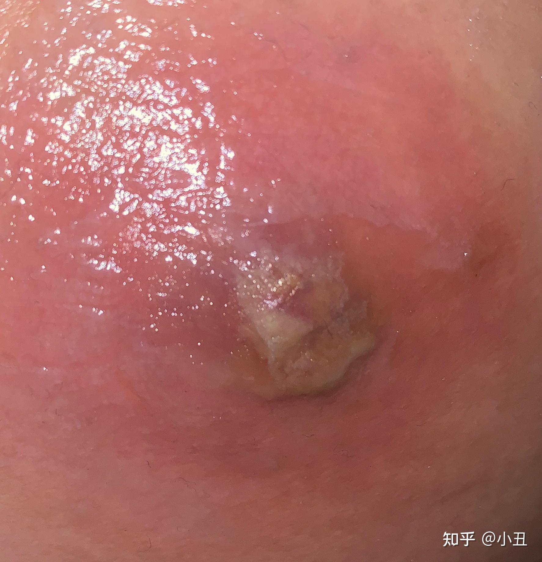 一个火疖子能大到什么地步