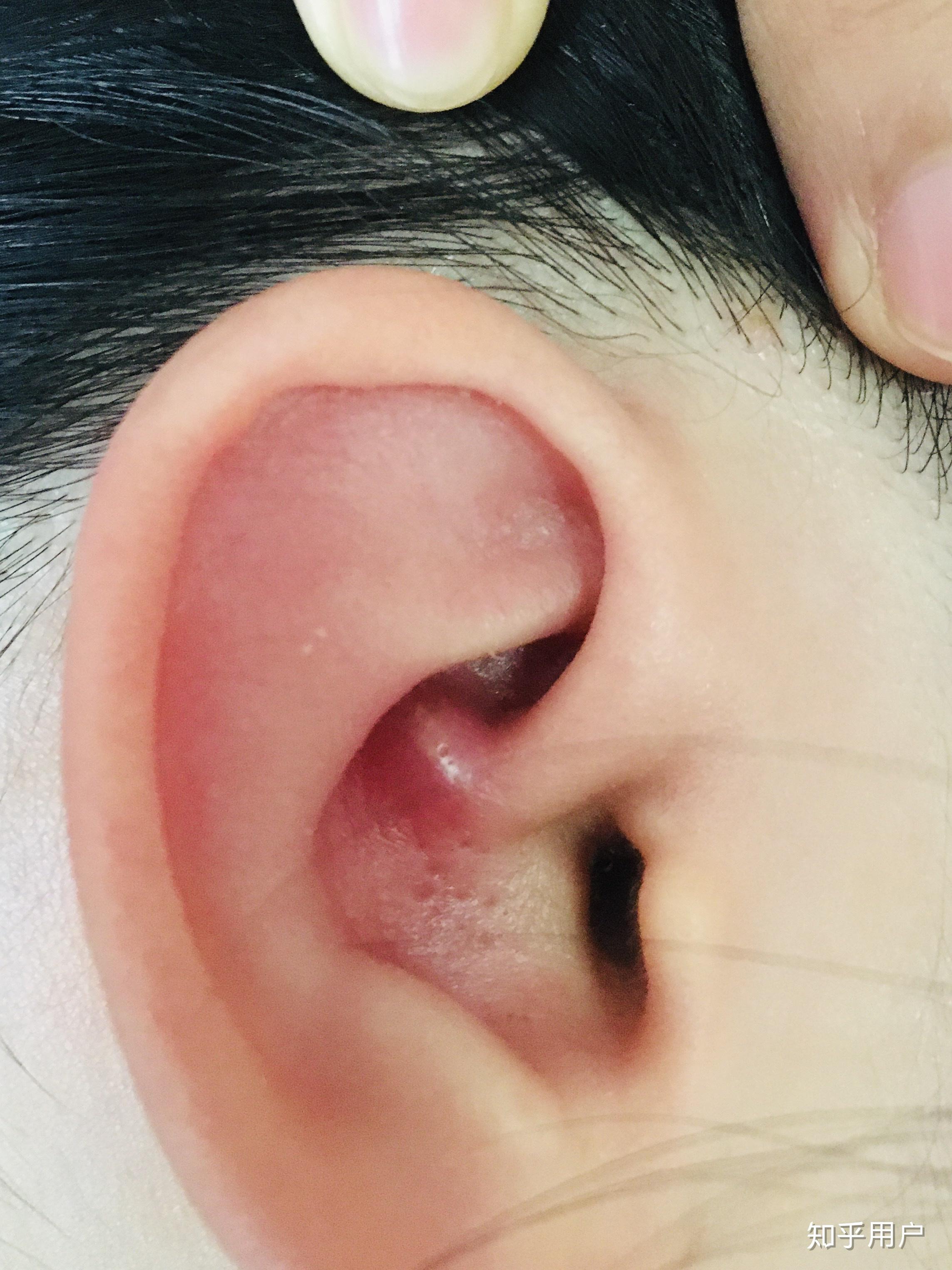 耳朵里长痘痘是一种什么体验