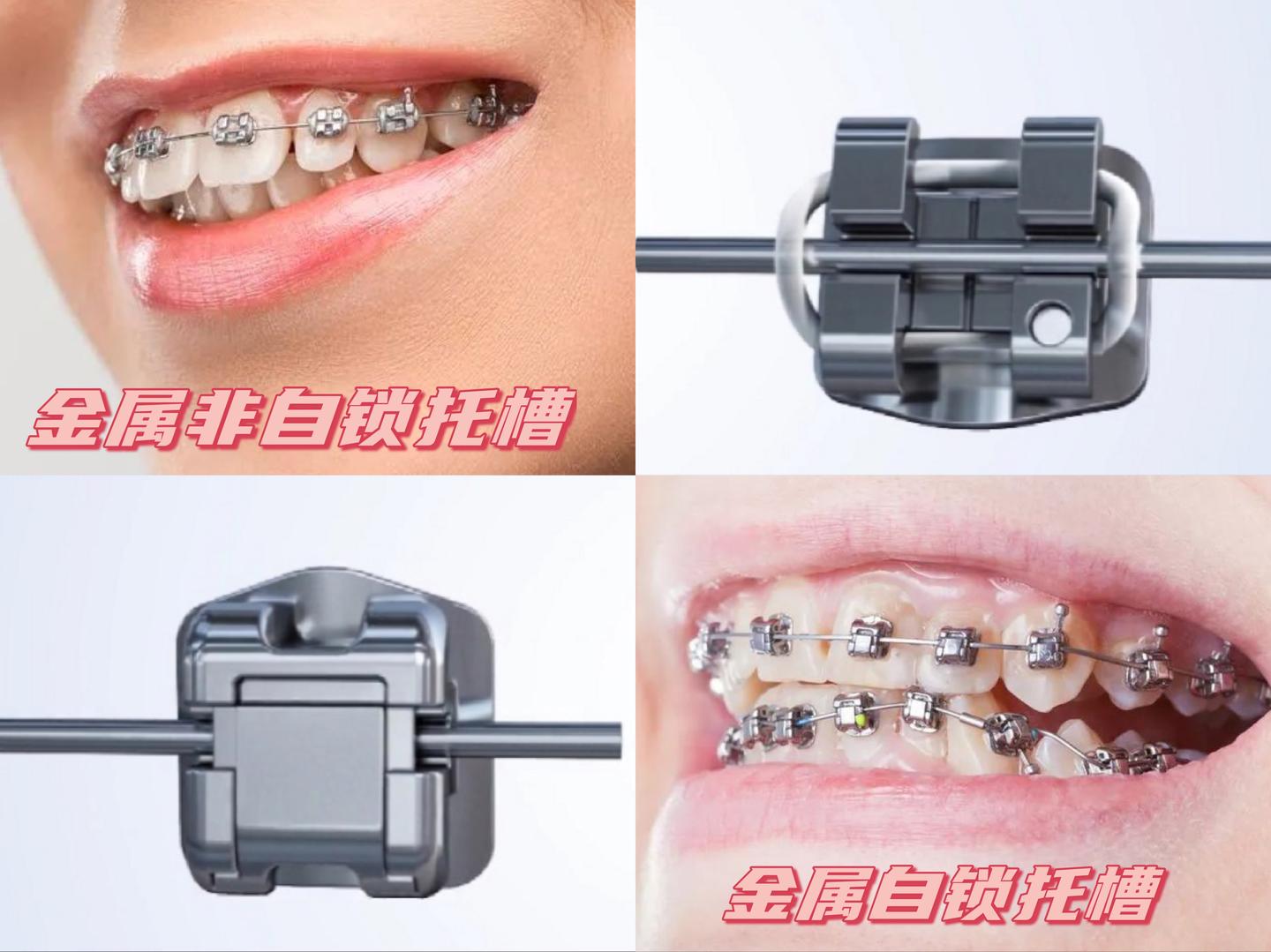 深圳牙齿矫正医生科普丨不同牙齿矫正器的区别丨传统金属vs金属自锁丨