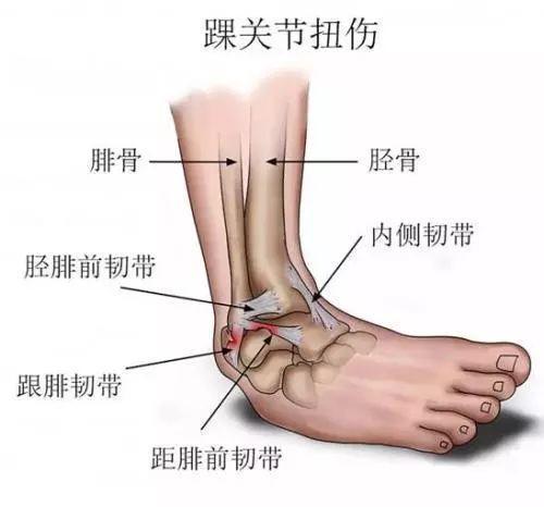 脚踝扭伤怎么办骨科医生为你揭秘崴脚4大误区