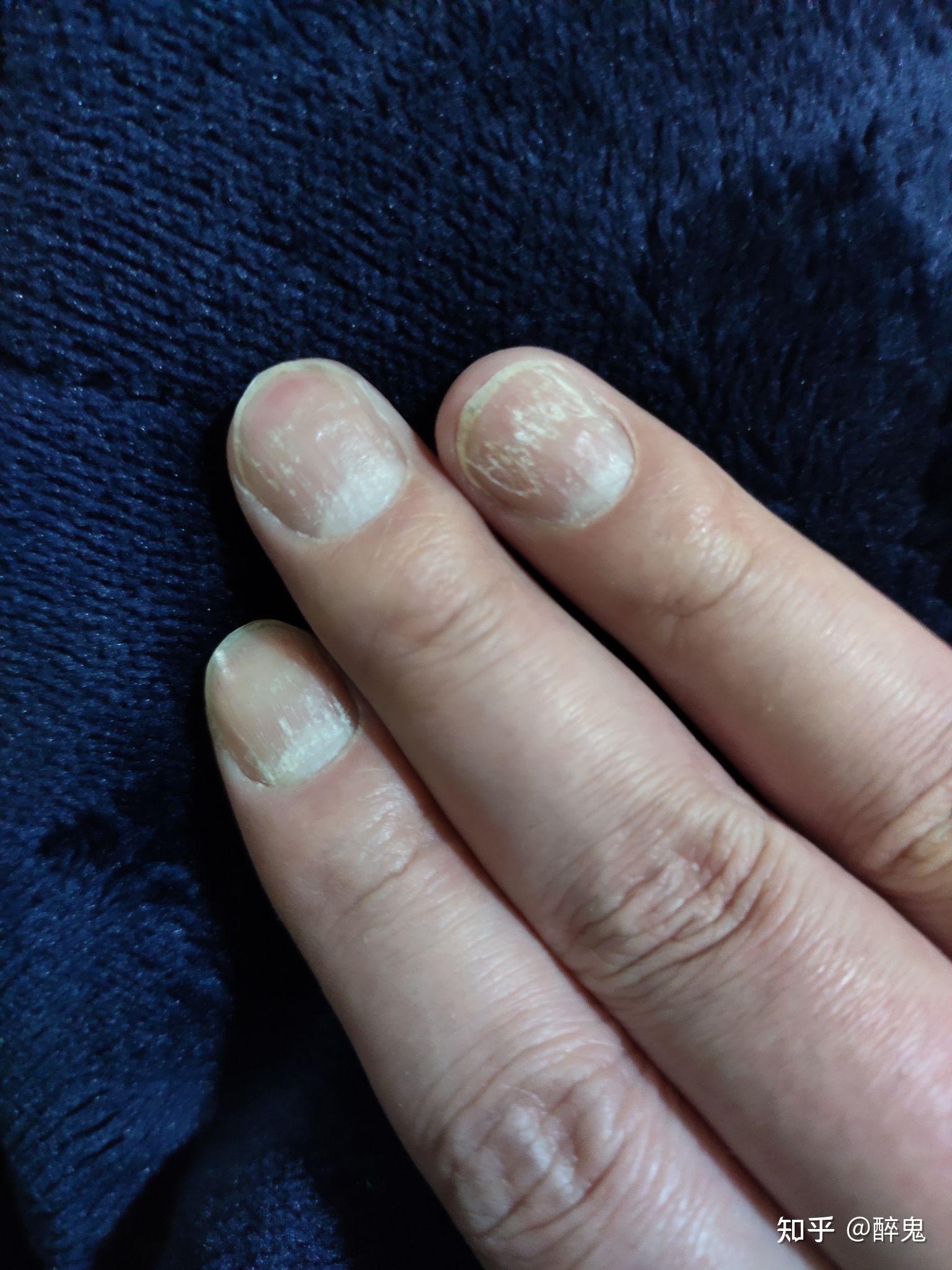 湿疹导致指甲变形怎么办