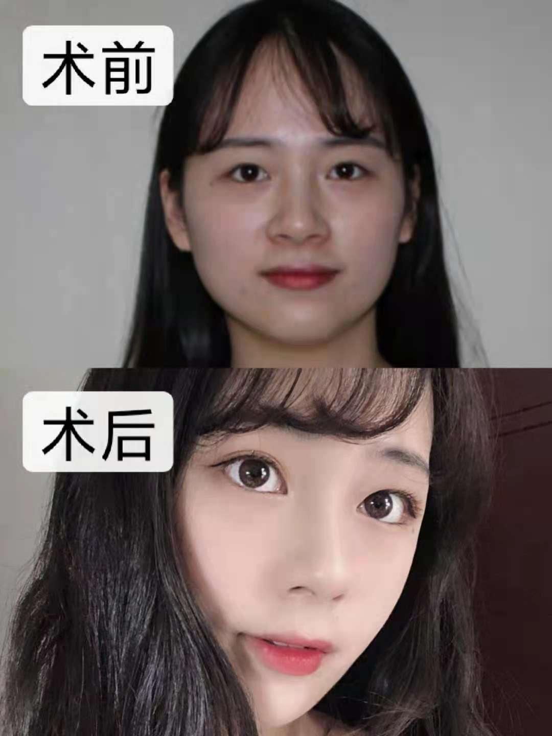 在合肥做了隆鼻手术后我从大鼻翼变成自然娇小妈生鼻——合肥隆鼻真实