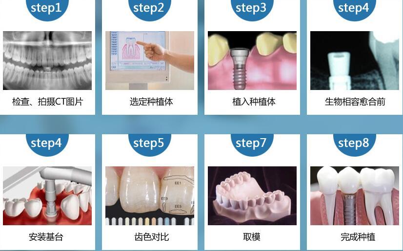 北京性价比高的种植牙医院,靠谱种植牙医生?种植牙干货分享!