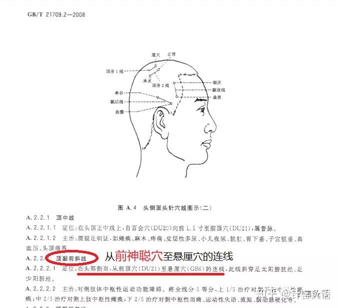 焦顺发头针疗效如何