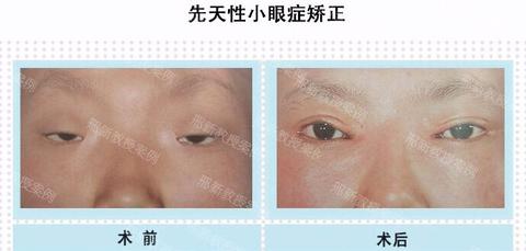 教授助理  围脖:邢新教授小助理邢新教授小助理先天性小眼症遗传吗?