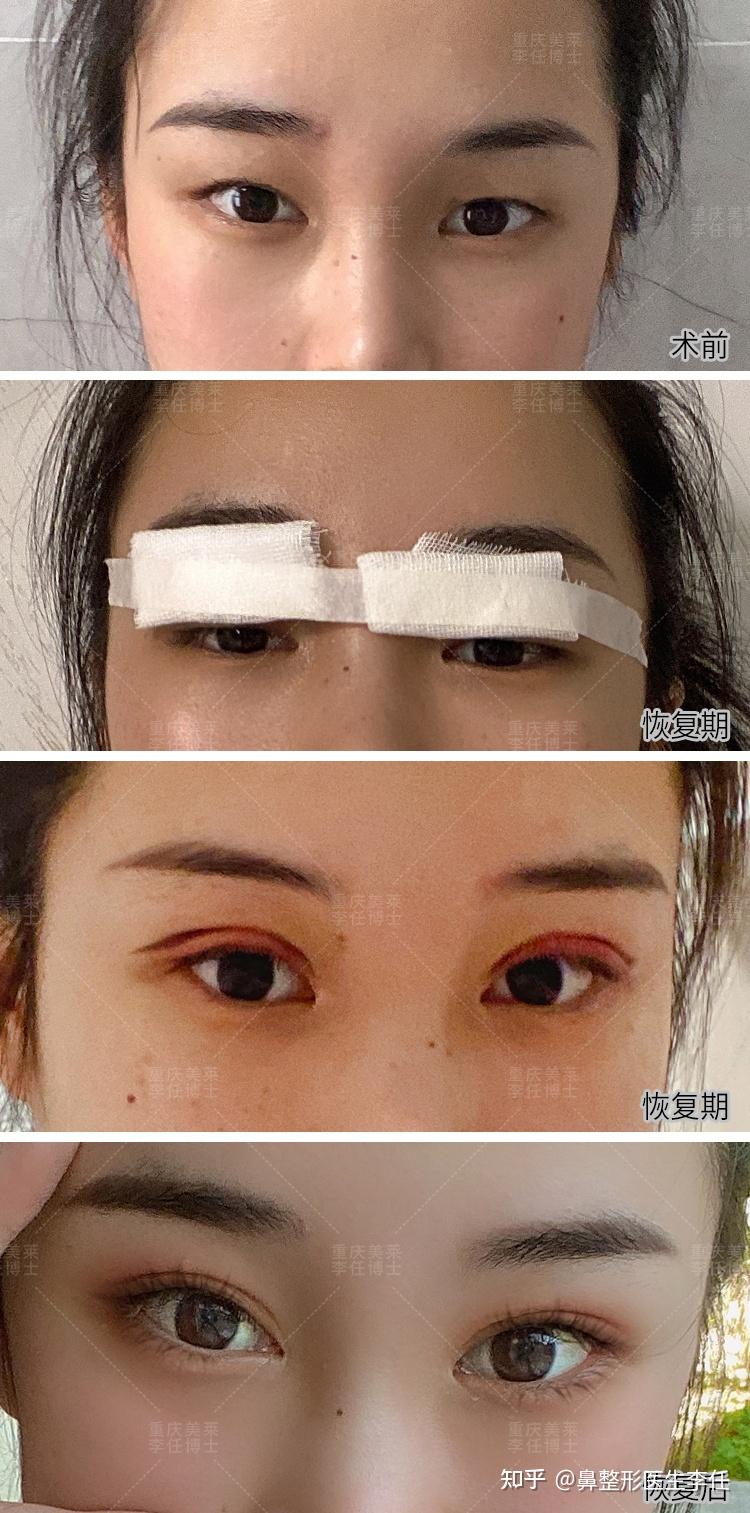 park双眼皮窄改宽用全切修复合适还是继续用park法合适呢