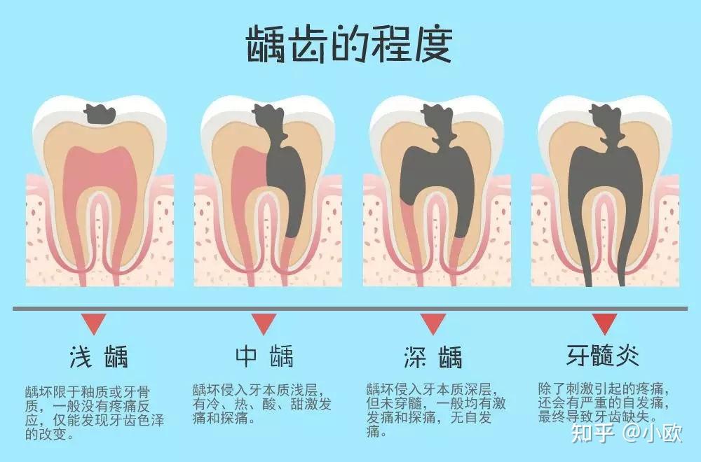 假如牙齿得了浅龋,可以只磨掉浅表性龋坏的小黑点而不补牙吗 知乎