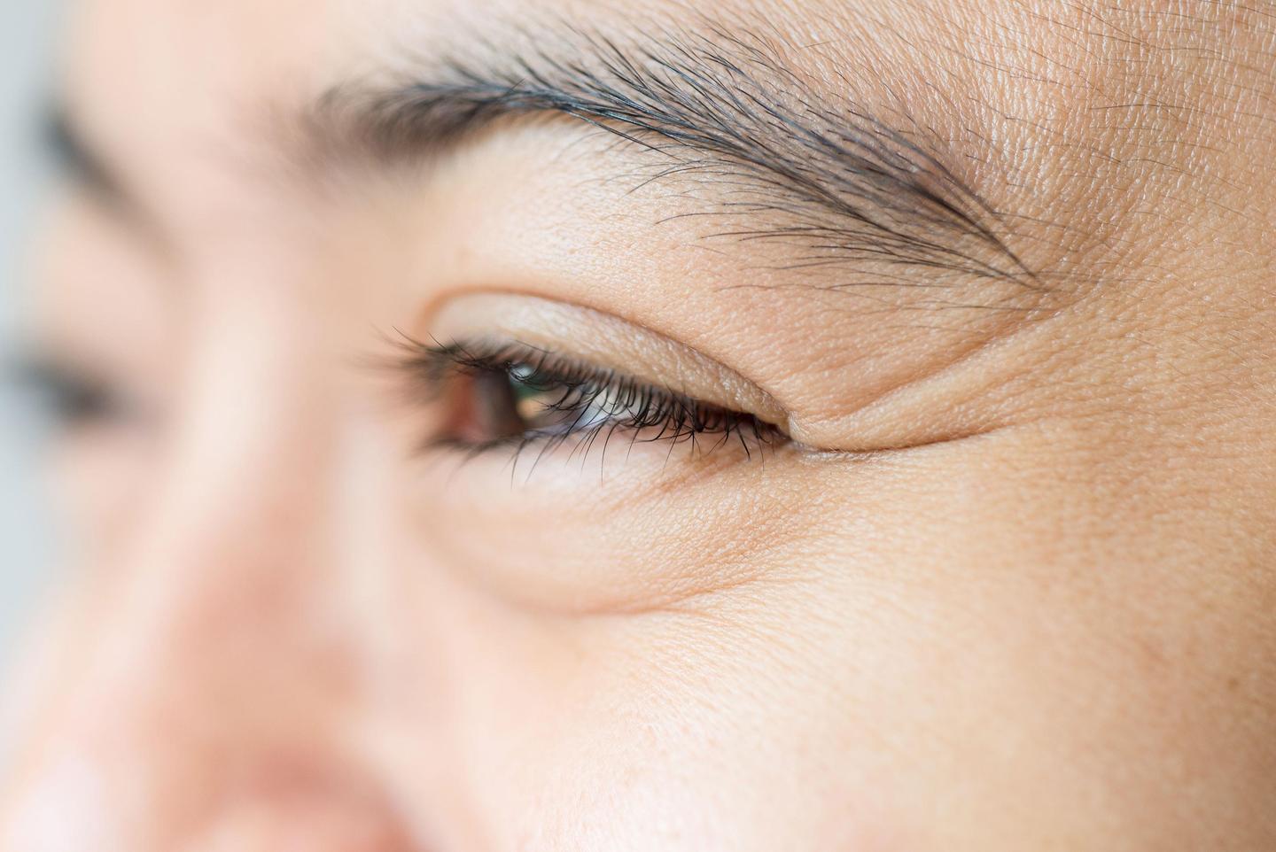 眼角纹多是什么原因你需要知道这些